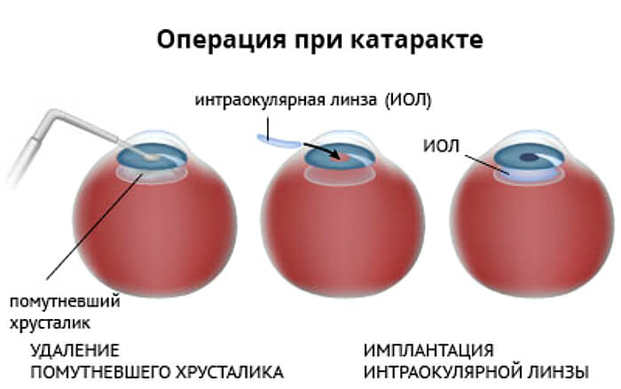 Операция катаракты