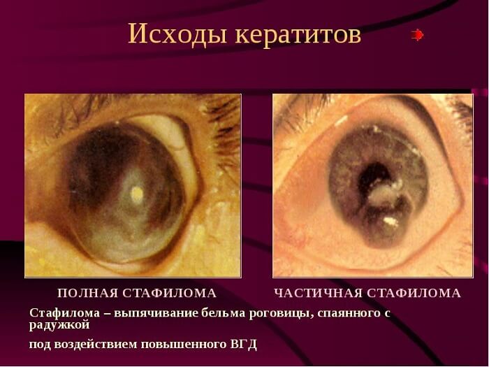 Основные исходы кератитов
