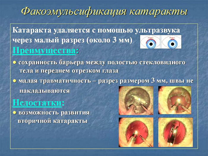 Особенности устранения катаракты