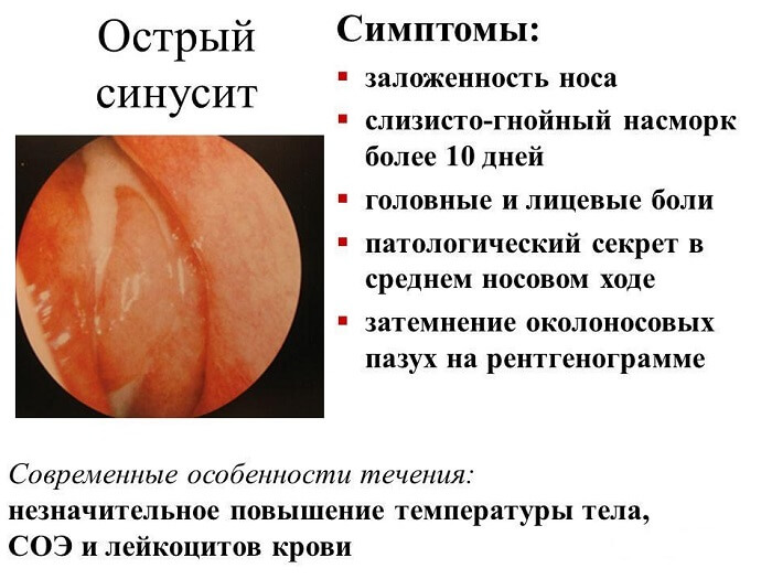 Острый синусит у человека