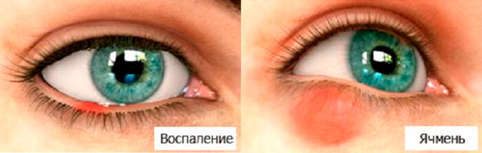 Отличие воспаления от ячменя