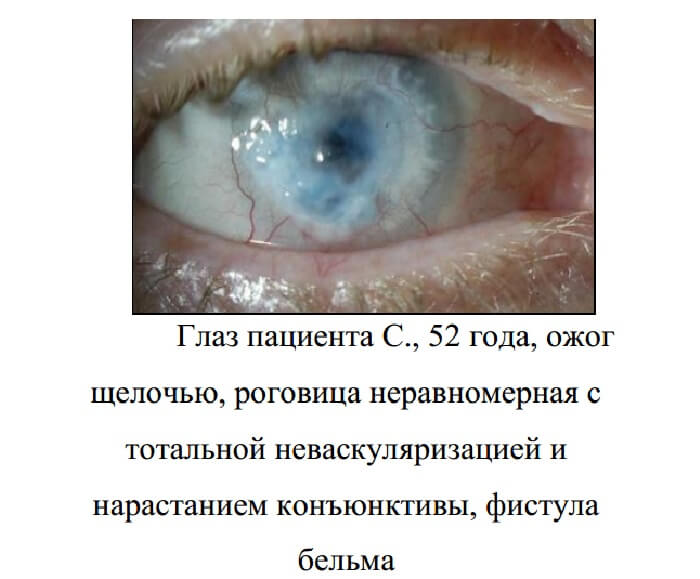 Ожоги роговицы глаза
