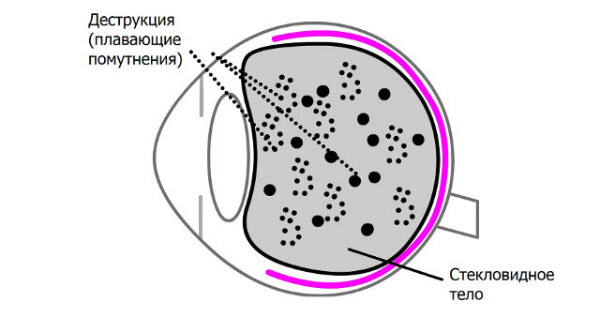 Плавающее помутнение глаза