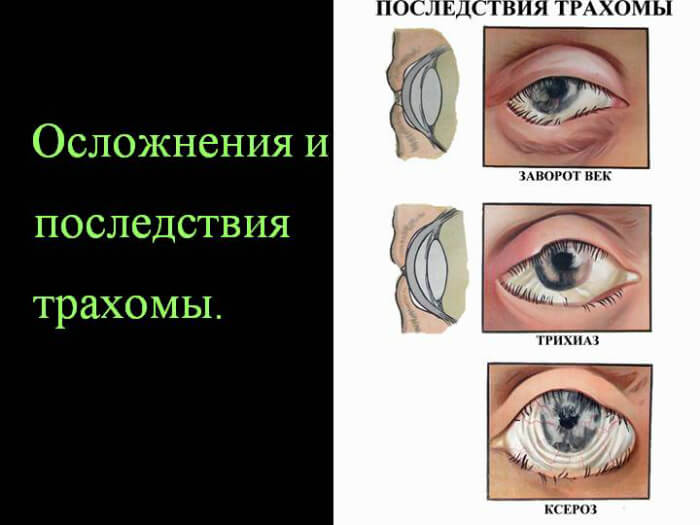 Последствия трахомы