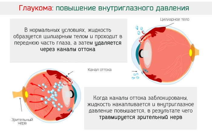 Повышение внутриглазного давления