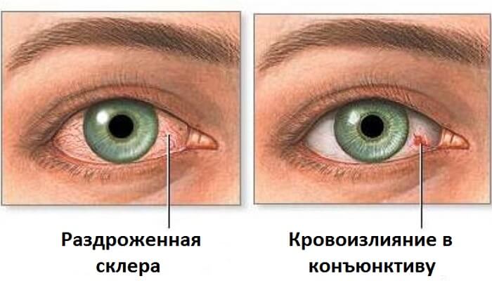 Причины покраснения глаз