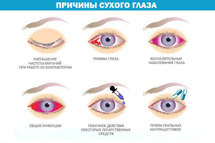 Причины сухого глаза