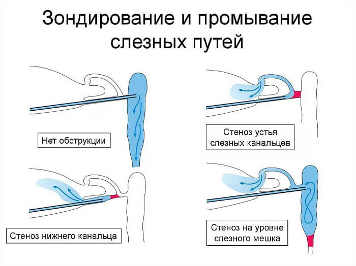 Промывание слезных путей