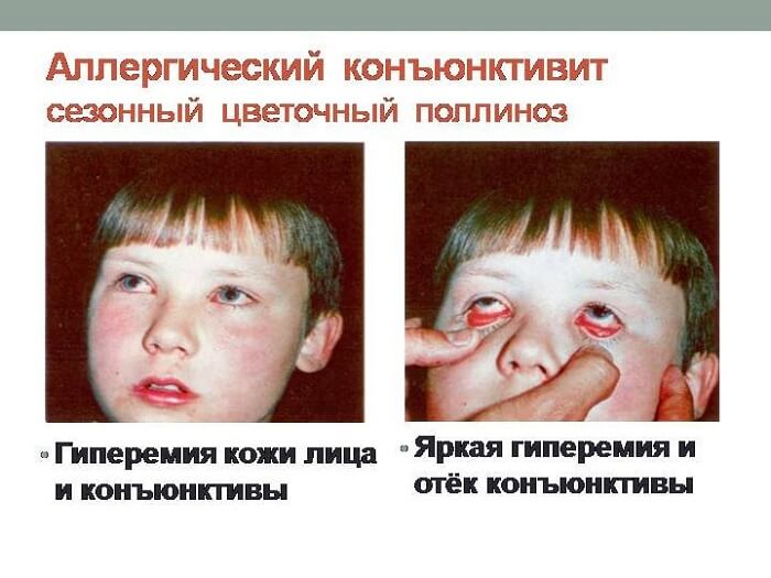 Проявления аллергического конъюнктивита