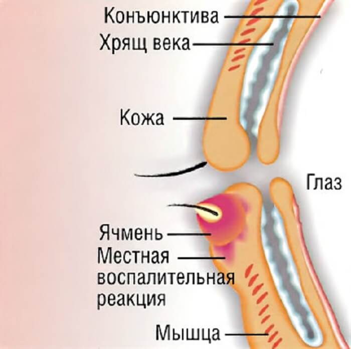 Как проявляется ячмень