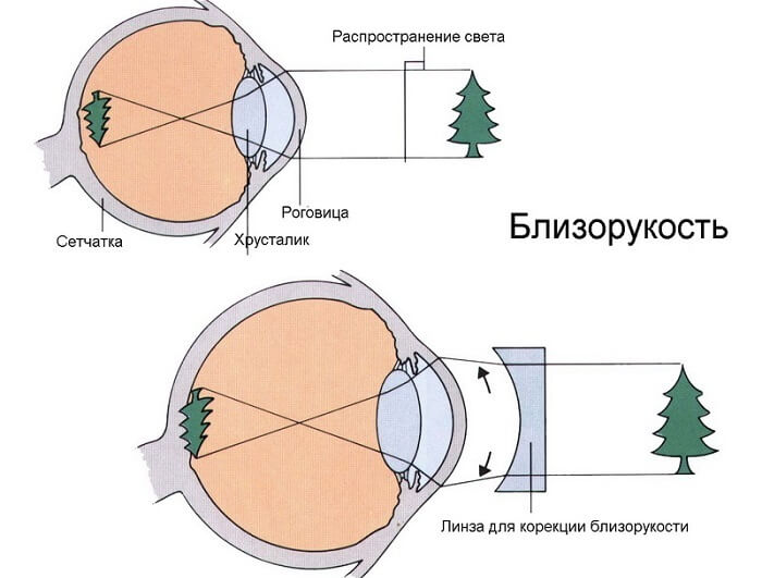 Распространение света при близорукости