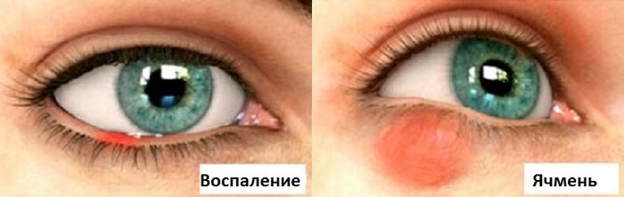 Различия ячменя от воспаления