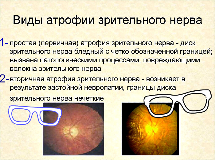 Разновидности атрофии нерва