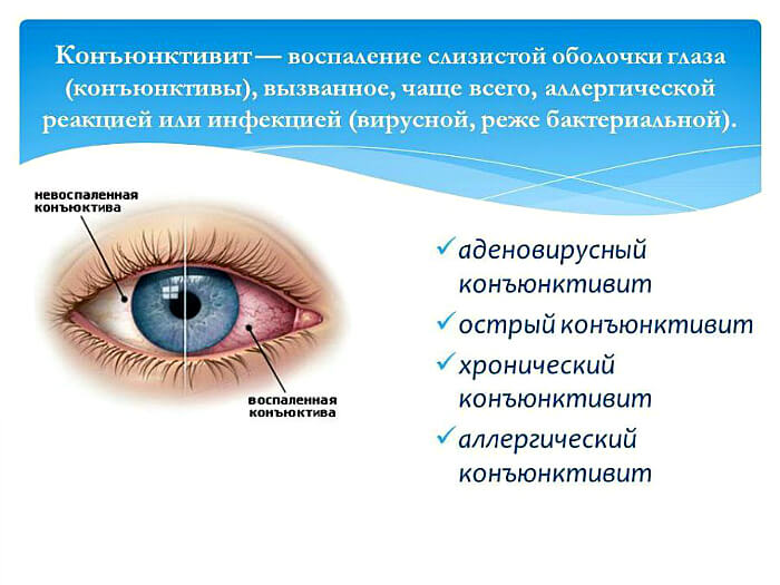 Разновидности конъюктивита