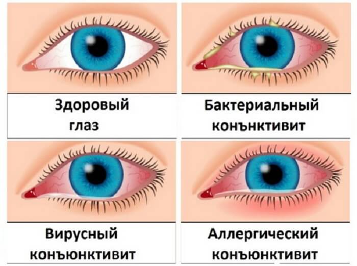 Разновидности конъюнкитивита