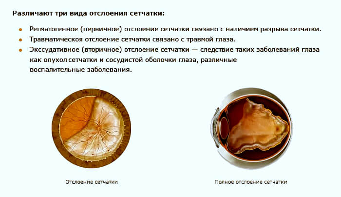 Разновидности заболевания