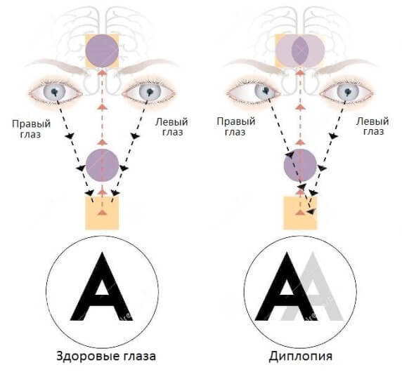 Схема диплопии