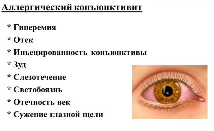 Симптомы аллергического конъюнктивита
