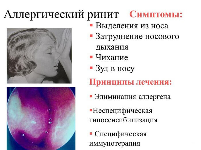 Симптомы аллергического ринита