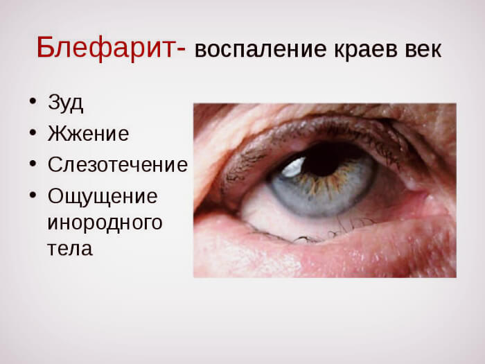 Симптомы воспаления век