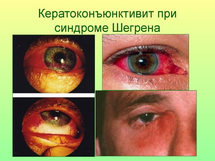 Синдром Шегрена у человека