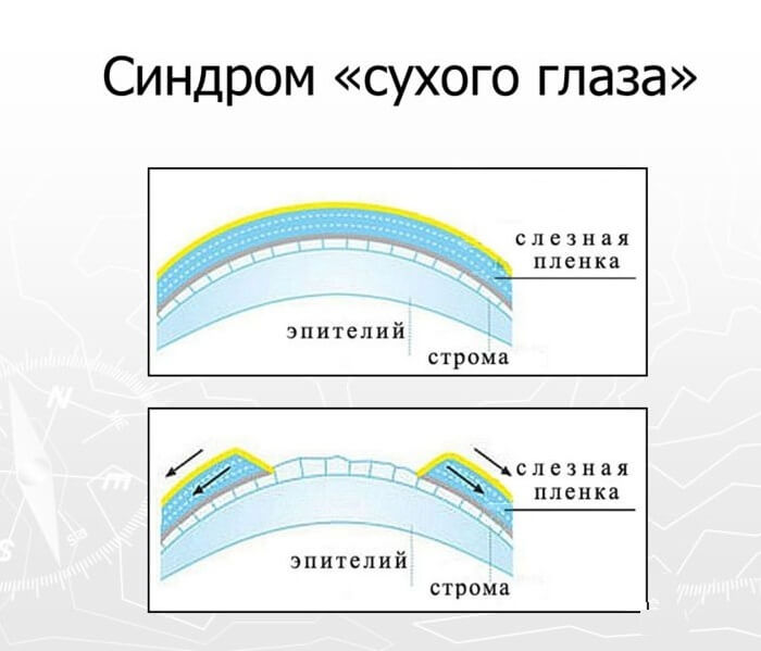 Синдром сухого глаза