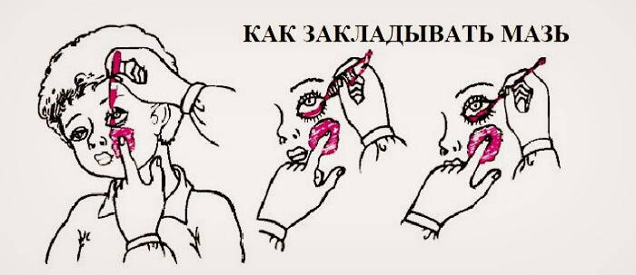 Способ закладывания мази