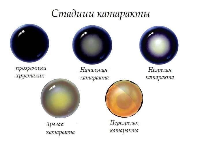 Стадии катаракты