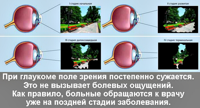 Стадии развития глаукомы