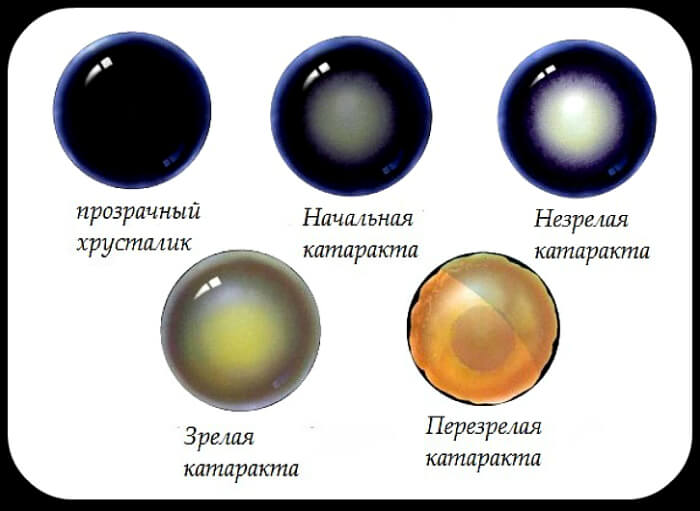 Стадии развития катаракты
