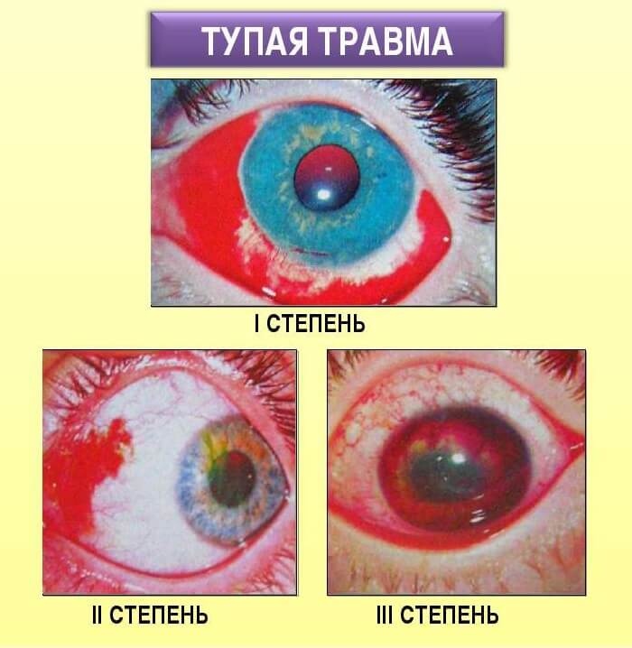 Стадии травмы глаза