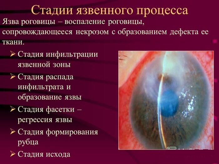 Стадии язвы