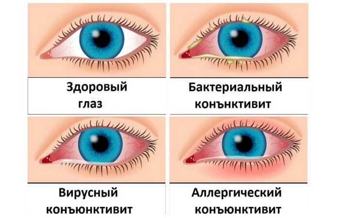 Типы конъюнктивита глаза