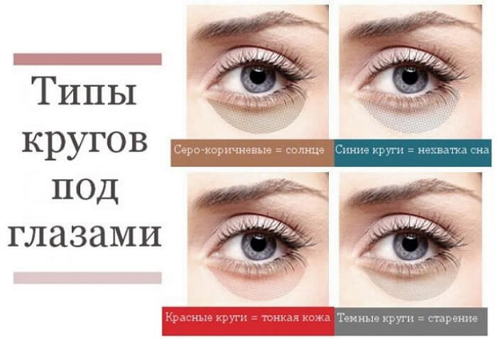 Типы кругов под глазами