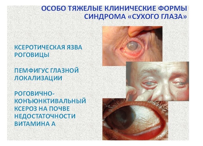 Тяжелые клинические формы