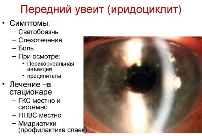 Увеит у человека
