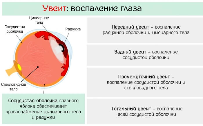 Увеит - воспаление роговицы