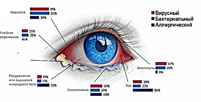 Виды конъюктивита