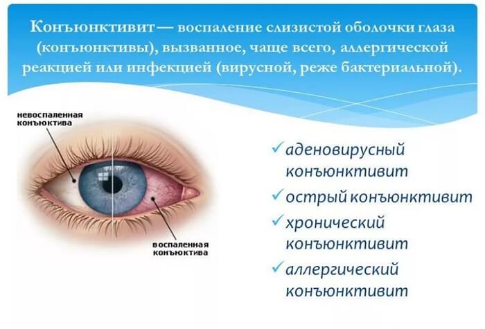 Виды конъюнктивита