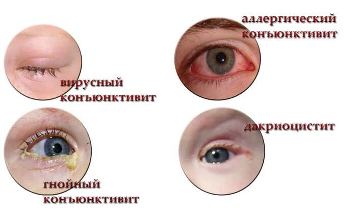 Виды коньюктивита