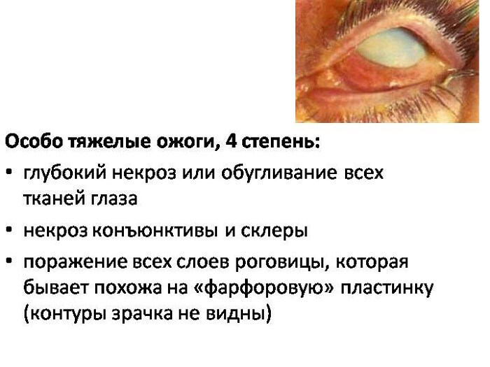 Виды ожогов роговицы