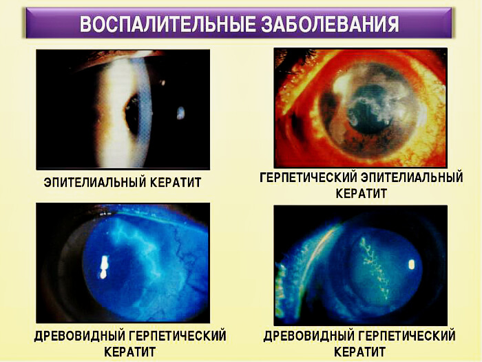 Виды воспаления