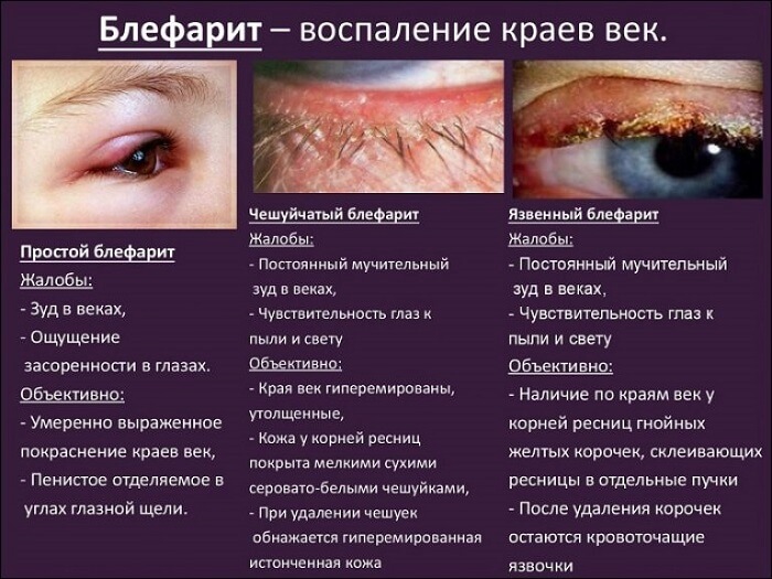 Воспаление краев век