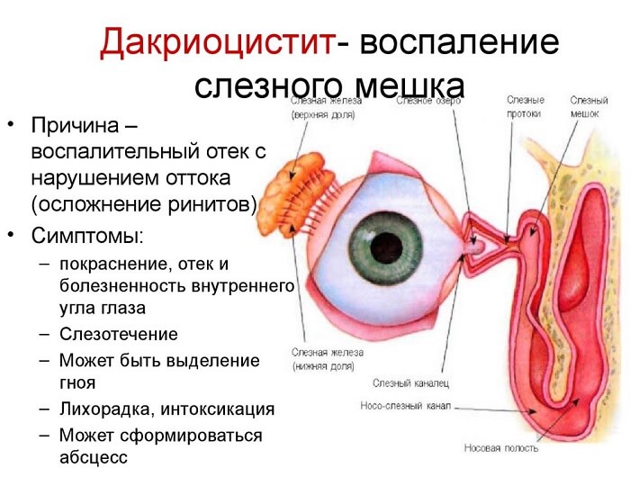 Воспаление слезного мешка