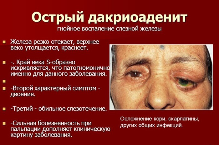 Воспаление слезной железы
