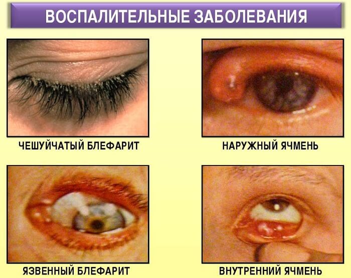 Воспалительные заболевания