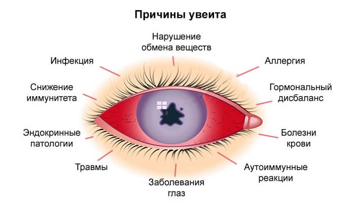 Возможные причины увеита