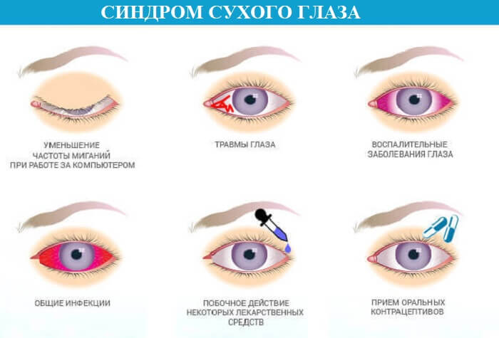 Возникновение синдрома сухого глаза