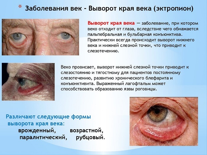 Выворот края века