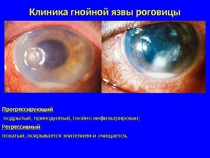 Язва роговицы